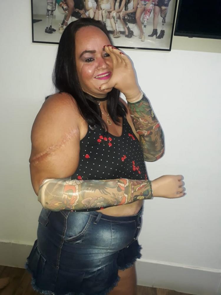 Mulher que teve mãos decepadas pelo marido ganha próteses com dinheiro de vaquinha em MT: 'Muito feliz'