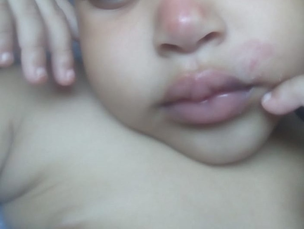 Mãe denuncia creche após filha de 2 anos voltar para casa com hematomas em Cuiabá