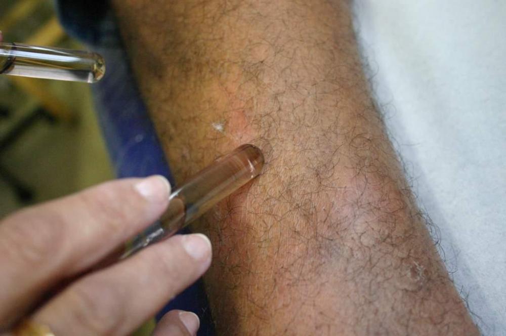 Protocolo clínico da hanseníase é tema de enquete voltada a profissionais da saúde