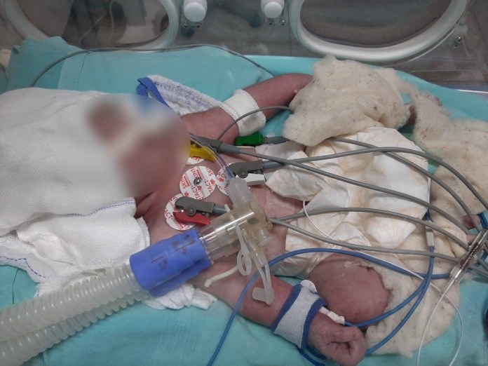 Recém-nascida vítima de escalpelamento durante o parto sai da UTI em Mato Grosso